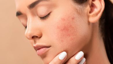 5 Proper skin care to overcome black spots